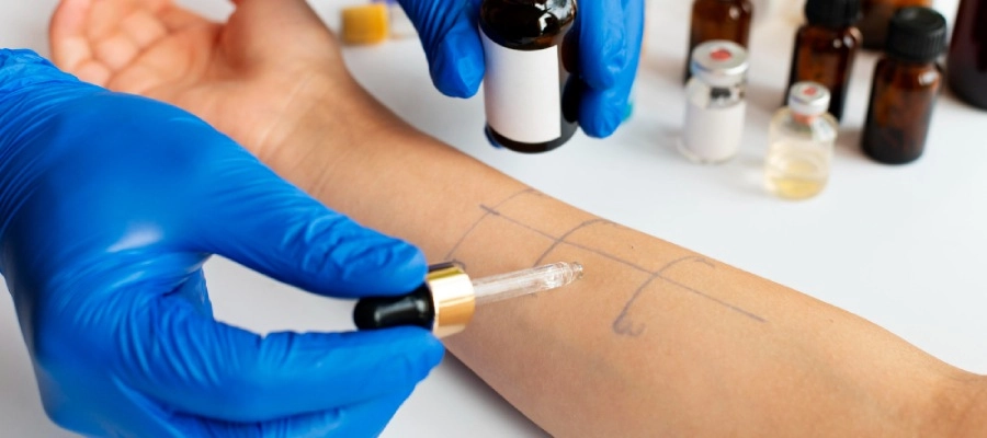 pessoa faz teste de alergia no braço