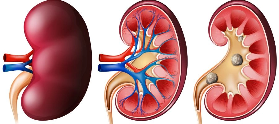 Imagem dio post O que é calculo renal 